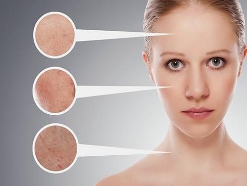 Sẹo rỗ là gì, làm thế nào để có thể ủi phẳng chúng một cách an toàn nhất