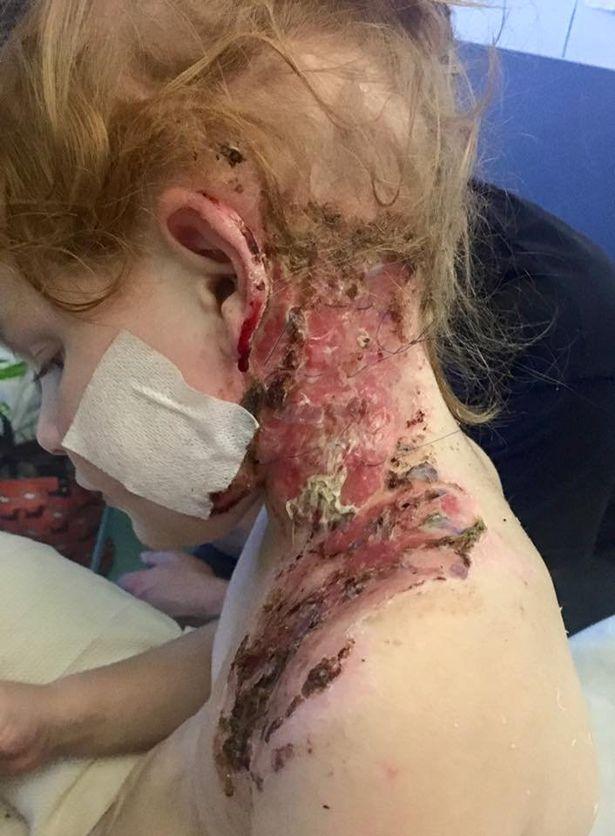 Kinh hoàng bé gái 4 tuổi bị bỏng nặng khi xem pháo hoa trong vườn nhà-2