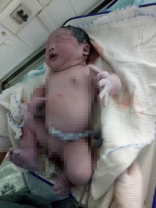 Bé trai chào đời với cân nặng kỷ lục 7,1kg ở Vĩnh Phúc-2