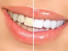 1001 cách làm trắng răng tự nhiên, rẻ tiền chẳng cần đi nha sĩ