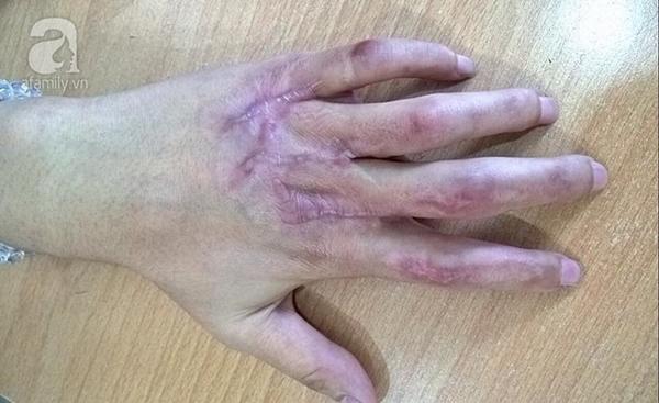 Tâm thư xúc động của cô gái 21 tuổi được tái sinh bàn tay dập nát vì máy cắt xốp-1