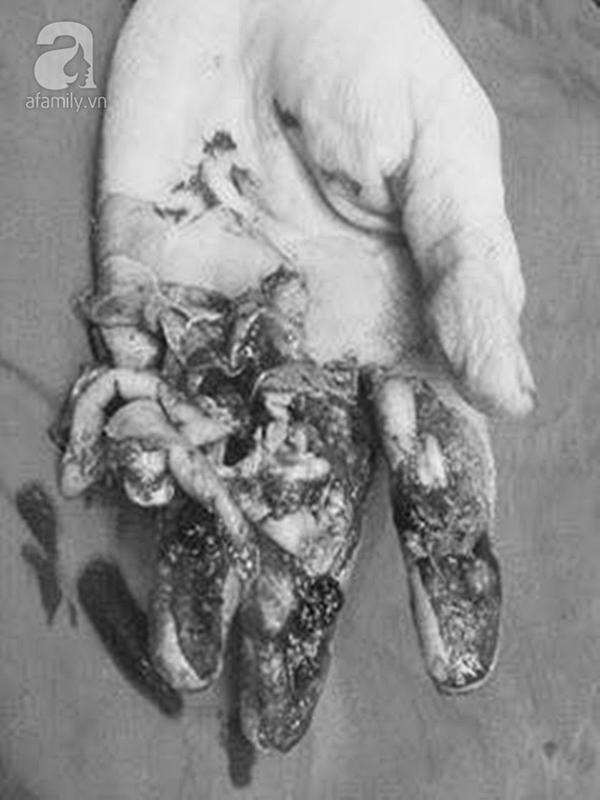 Tâm thư xúc động của cô gái 21 tuổi được tái sinh bàn tay dập nát vì máy cắt xốp-2