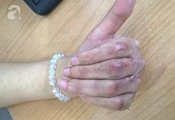 Tâm thư xúc động của cô gái 21 tuổi được tái sinh bàn tay dập nát vì máy cắt xốp-3