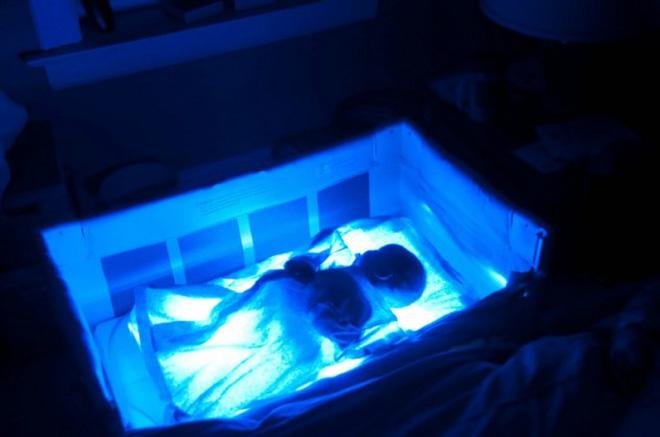 Vì một phút sơ sẩy của y tá, bé sơ sinh 3 ngày tuổi đã bị cướp mất đi hình hài-1