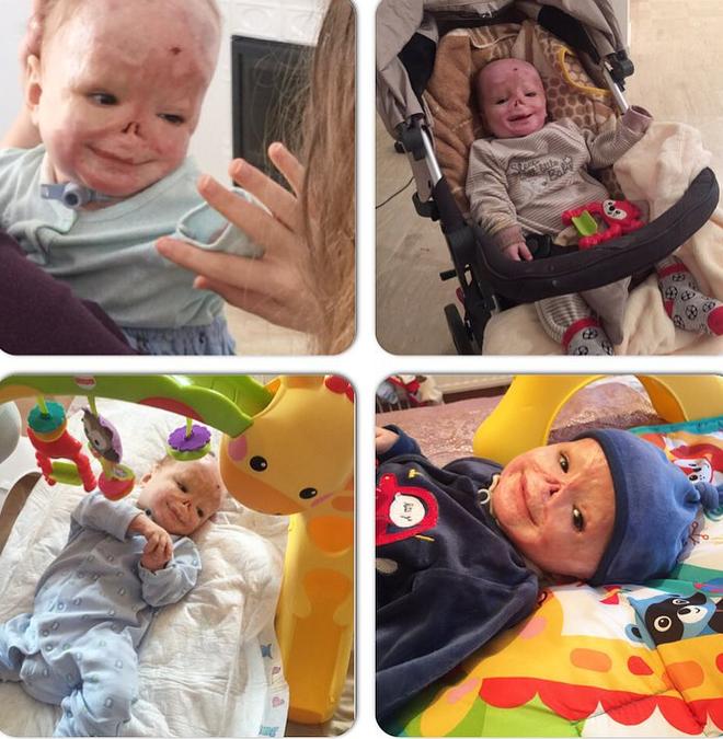 Vì một phút sơ sẩy của y tá, bé sơ sinh 3 ngày tuổi đã bị cướp mất đi hình hài-3