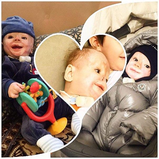 Vì một phút sơ sẩy của y tá, bé sơ sinh 3 ngày tuổi đã bị cướp mất đi hình hài-4