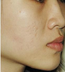 Điểm danh những loại sẹo mụn xấu xí làm chị em đau khổ và cách trị chuẩn khỏi chỉnh-1