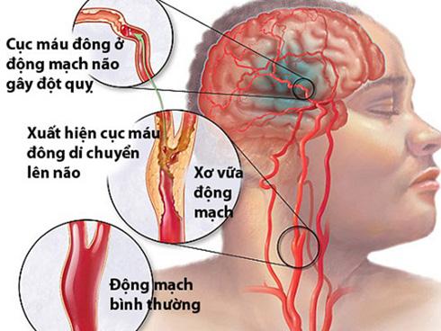 Cảnh báo những cái chết do đột quỵ ở người trẻ