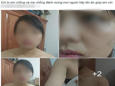 Hà Nội: Từ chối nộp hết tiền kiếm được hàng tháng cho mẹ chồng, người phụ nữ bị nhà chồng đánh thâm tím người