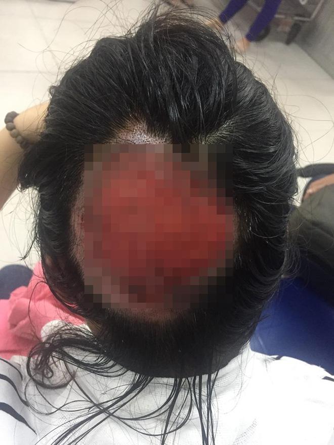 Tai nạn khi uốn tóc: Tóc cuốn vào ống dẫn nhiệt, nữ bác sĩ bỏng sâu, tróc gần như toàn bộ da đầu-1