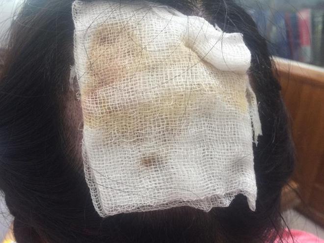 Tai nạn khi uốn tóc: Tóc cuốn vào ống dẫn nhiệt, nữ bác sĩ bỏng sâu, tróc gần như toàn bộ da đầu-2