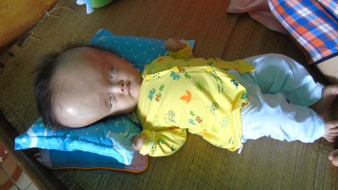 Cuộc sống đau đớn của bé gái 8 tháng tuổi mồ côi cha, cái đầu như muốn nổ tung vì căn bệnh não úng thủy-3