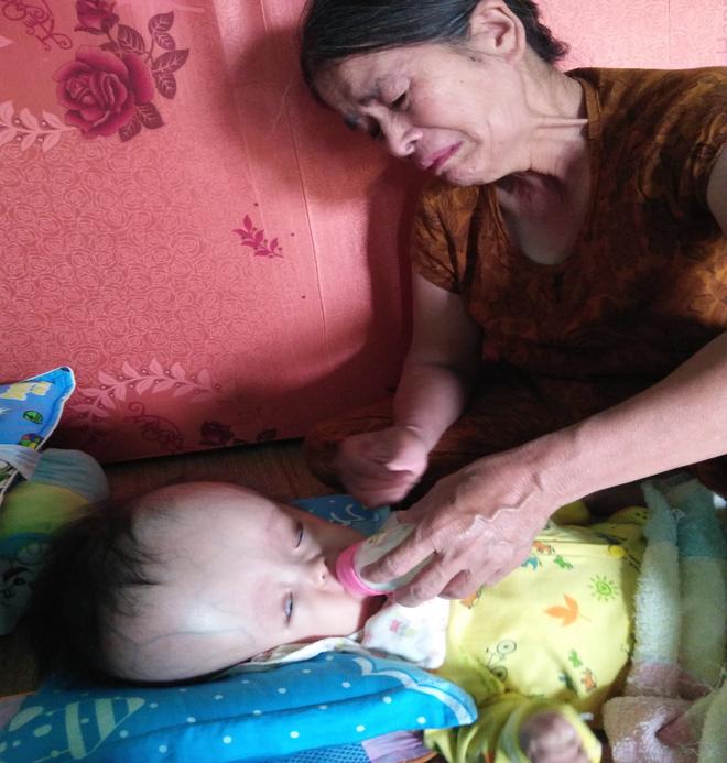 Cuộc sống đau đớn của bé gái 8 tháng tuổi mồ côi cha, cái đầu như muốn nổ tung vì căn bệnh não úng thủy-4