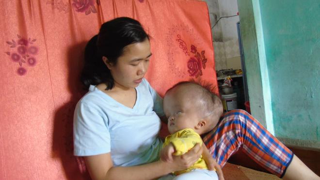 Cuộc sống đau đớn của bé gái 8 tháng tuổi mồ côi cha, cái đầu như muốn nổ tung vì căn bệnh não úng thủy-5