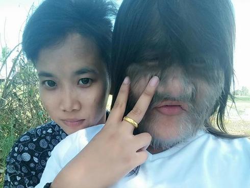 Đau khổ cả đời cuối cùng 'cô gái người sói' đã tìm được tình yêu đích thực