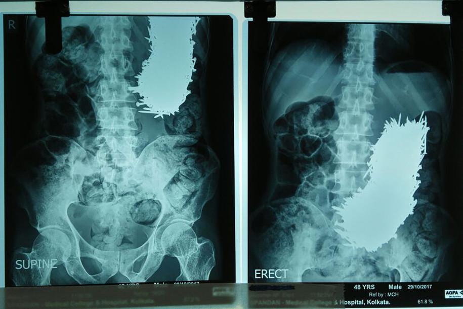 Kinh hoàng: Người đàn ông nuốt 600 cái đinh-1