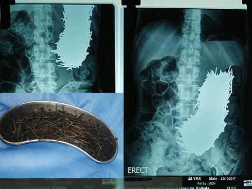 Những phương pháp chữa bệnh kỳ lạ trong lịch sử loài người-7