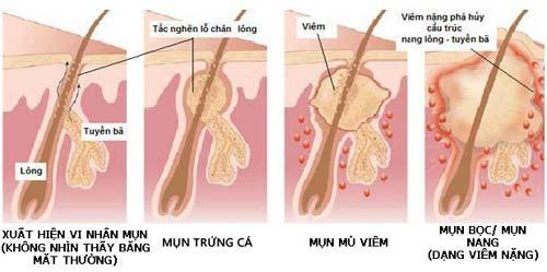 Bác sĩ da liễu tư vấn cách ngừa và trị mụn-3