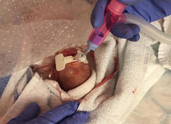 Cuộc chiến giành sự sống của em bé sinh non nặng hơn 4 lạng-2