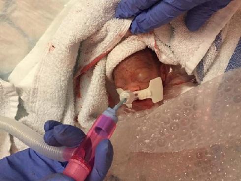 Cuộc chiến giành sự sống của em bé sinh non nặng hơn 4 lạng