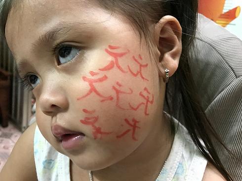 Nhập viện vì để thầy cúng vẽ bùa lên mặt điều trị nhiễm trùng hàm mặt