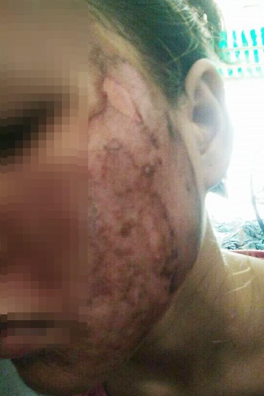 Cô gái lột da Đông y bị bỏng nặng và cuộc chiến giữa bác sĩ thẩm mỹ với kem trộn biến tướng-4