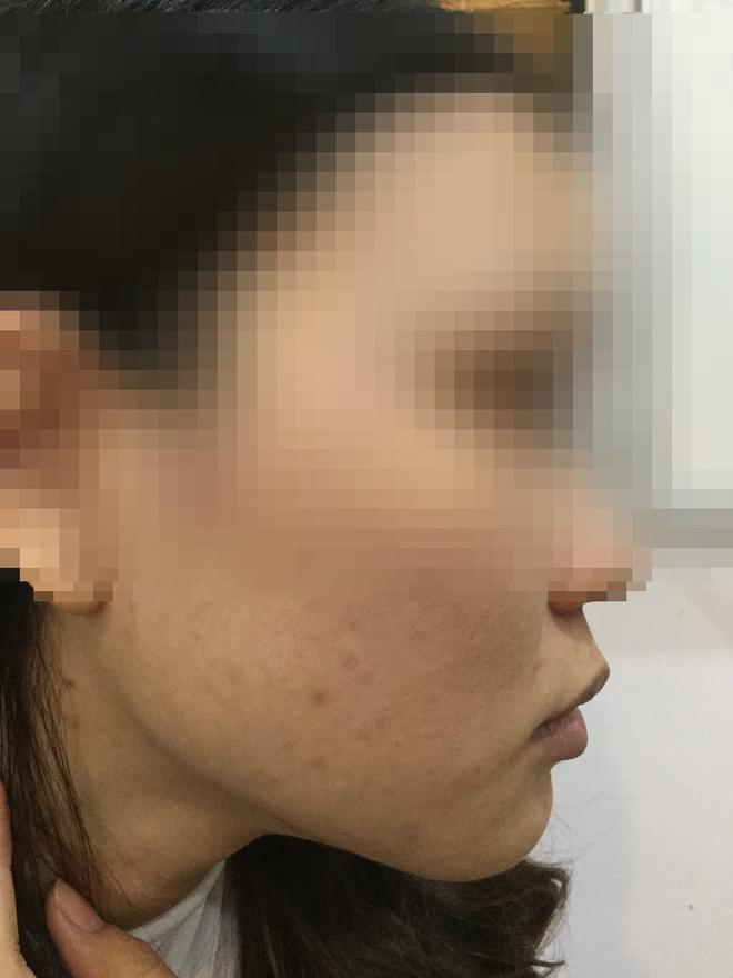 Cô gái lột da Đông y bị bỏng nặng và cuộc chiến giữa bác sĩ thẩm mỹ với kem trộn biến tướng-6