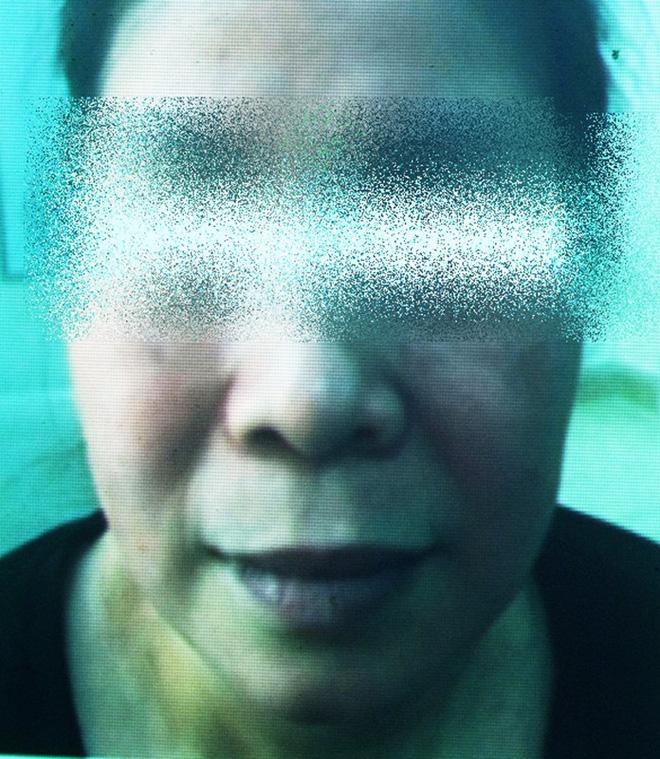 Cô gái lột da Đông y bị bỏng nặng và cuộc chiến giữa bác sĩ thẩm mỹ với kem trộn biến tướng-8