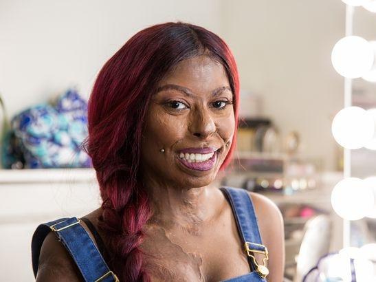 Người phụ nữ có gương mặt 'quỷ' đã luôn muốn chết đi cho xong đến khi gặp được người đàn ông đặc biệt