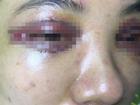 Hà Nội: Cô gái trẻ mắt thâm đen, mặt biến dạng sau khi đi làm mí ở spa