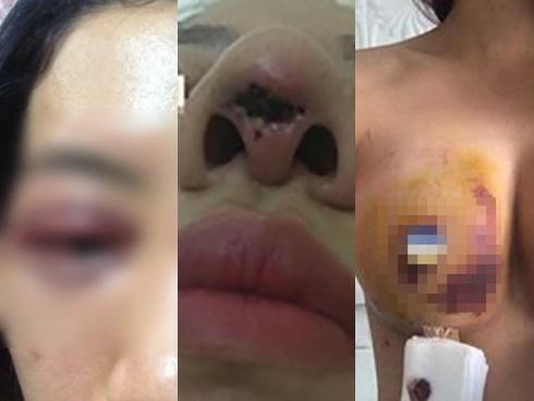 Bác sĩ thẩm mỹ rùng mình hút ra 20 cốc mủ từ ngực nạn nhân biến chứng nặng sau khi tiêm Filler rởm-5