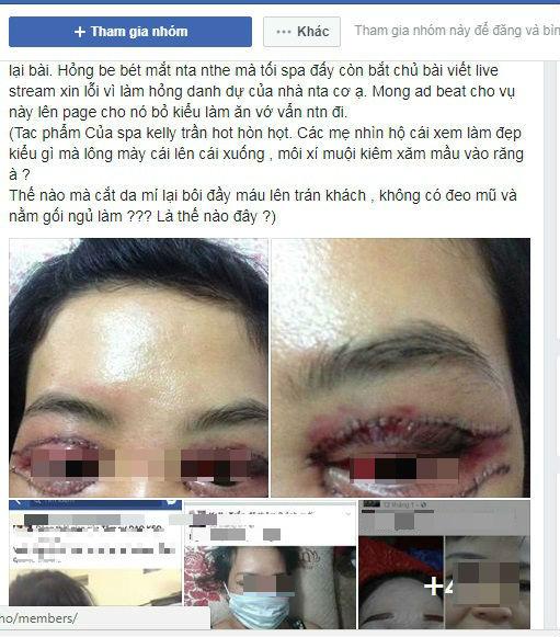 Cô gái Hà Nội mắt thâm đen sau khi cắt mí ở spa lần đầu lên tiếng sau sự cố-1