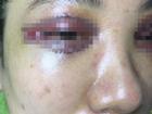 Cô gái Hà Nội mắt thâm đen sau khi cắt mí ở spa lần đầu lên tiếng sau sự cố