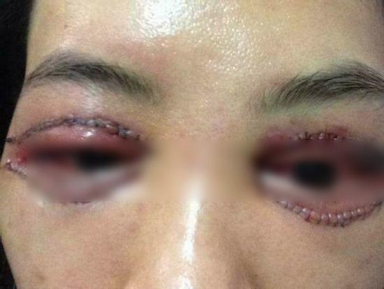 Bác sĩ thẩm mỹ nói về vụ 'cắt mí gây bão': có thể sưng nề và đỏ sau thủ thuật, nhưng về mỹ quan thì ca này hỏng