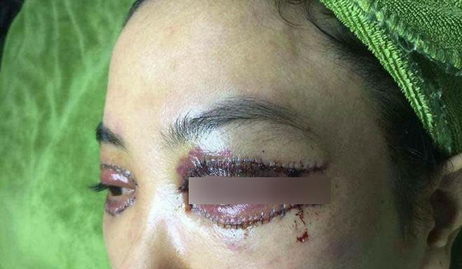 Bác sĩ thẩm mỹ nói về vụ cắt mí gây bão: có thể sưng nề và đỏ sau thủ thuật, nhưng về mỹ quan thì ca này hỏng-2