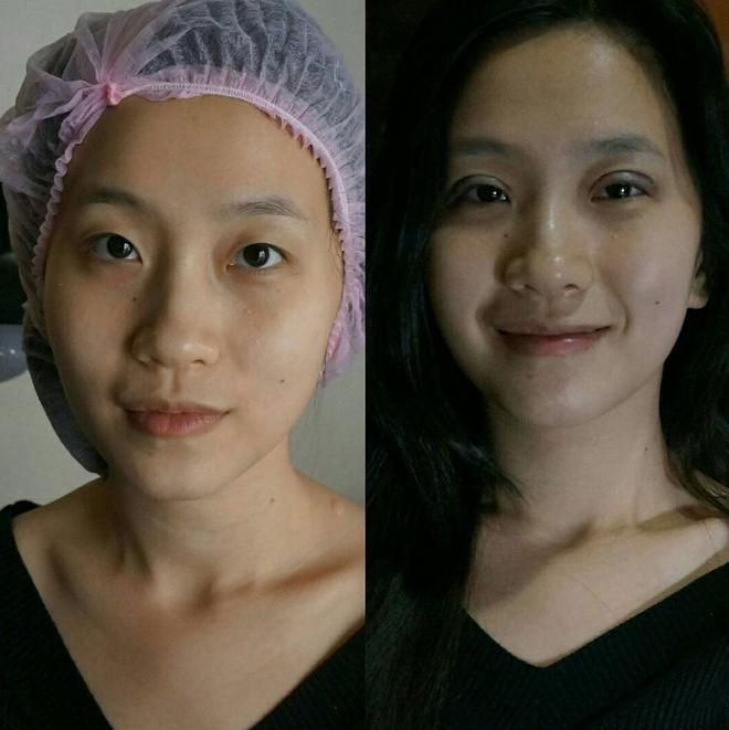 Bác sĩ thẩm mỹ nói về vụ cắt mí gây bão: có thể sưng nề và đỏ sau thủ thuật, nhưng về mỹ quan thì ca này hỏng-3