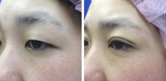 Bác sĩ thẩm mỹ nói về vụ cắt mí gây bão: có thể sưng nề và đỏ sau thủ thuật, nhưng về mỹ quan thì ca này hỏng-4