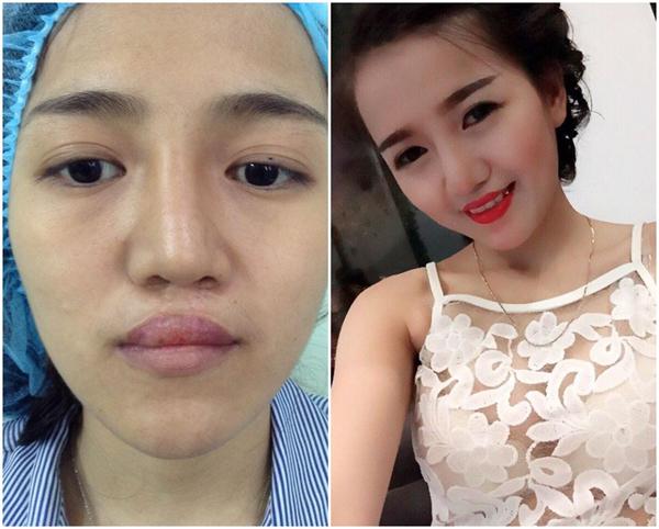Từ cô gái hở hàm ếch thiếu tự tin, 9X lột xác ấn tượng sau phẫu thuật thẩm mỹ-1