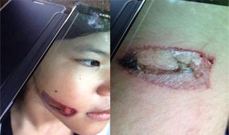 Bé gái bị bạo hành bằng sắt nung đỏ dí vào hai cánh tay-1