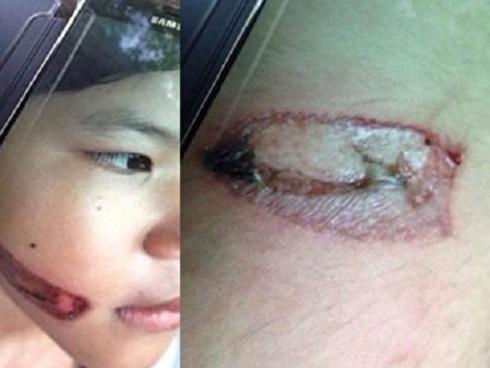 Bé gái bị bạo hành bằng sắt nung đỏ dí vào hai cánh tay