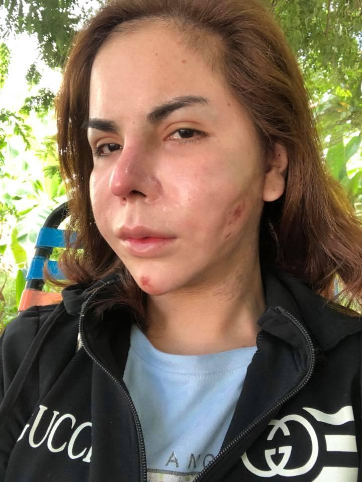 Phát hoảng với gương mặt biến dạng khủng khiếp sau thẩm mỹ của hot girl chuyển giới Linda-2