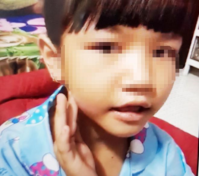 Khởi tố vụ bé gái nghi bị dí sắt nóng vào mặt-1