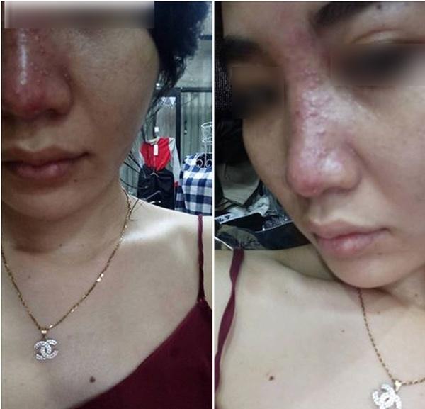 Tiêm filler nâng mũi tưởng ngon ăn, cô gái khóc thét khi biết mũi có thể hoại tử vì tiêm trúng tĩnh mạch-1