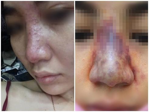Tiêm filler nâng mũi tưởng ngon ăn, cô gái khóc thét khi biết mũi có thể hoại tử vì tiêm trúng tĩnh mạch