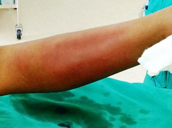 Bé trai suýt mất chân vì chữa thầy lang vườn-1