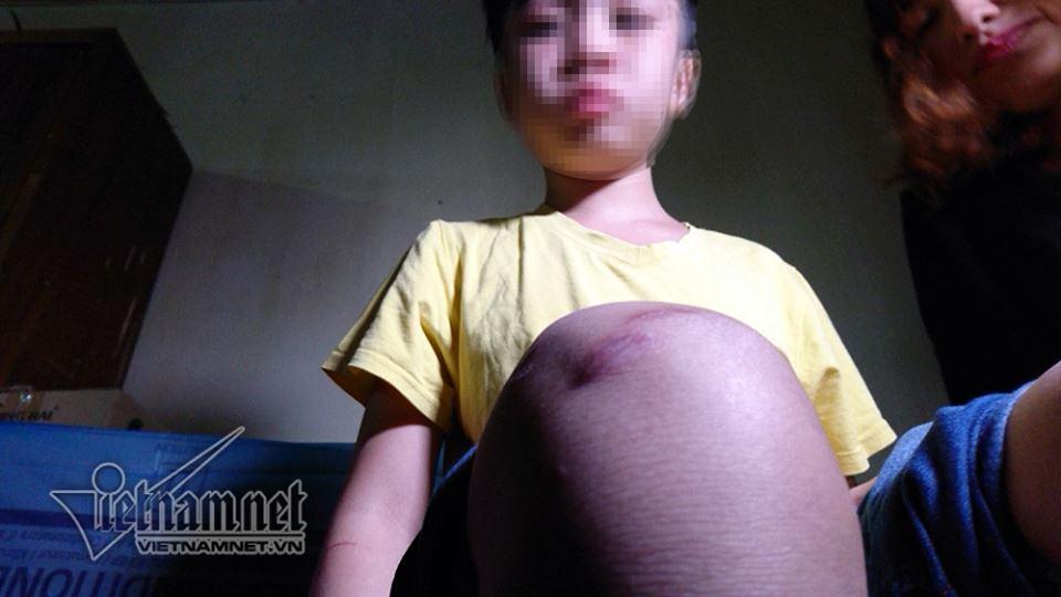 Bé trai bị bố và mẹ kế đánh rạn sọ não xin tha cho bố-6