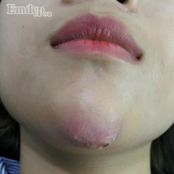 Bác sĩ thẩm mỹ rùng mình hút ra 20 cốc mủ từ ngực nạn nhân biến chứng nặng sau khi tiêm Filler rởm-1