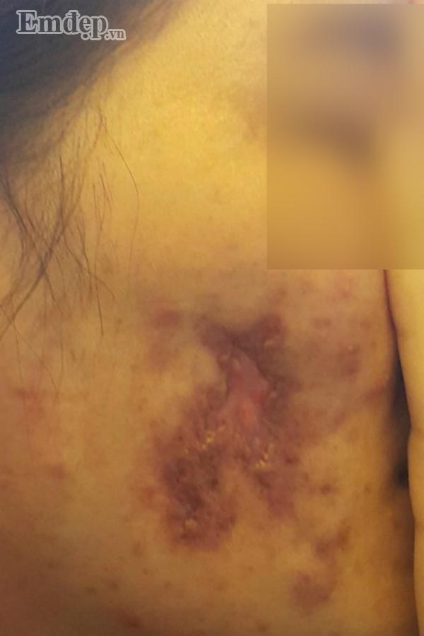 Bác sĩ thẩm mỹ rùng mình hút ra 20 cốc mủ từ ngực nạn nhân biến chứng nặng sau khi tiêm Filler rởm-2