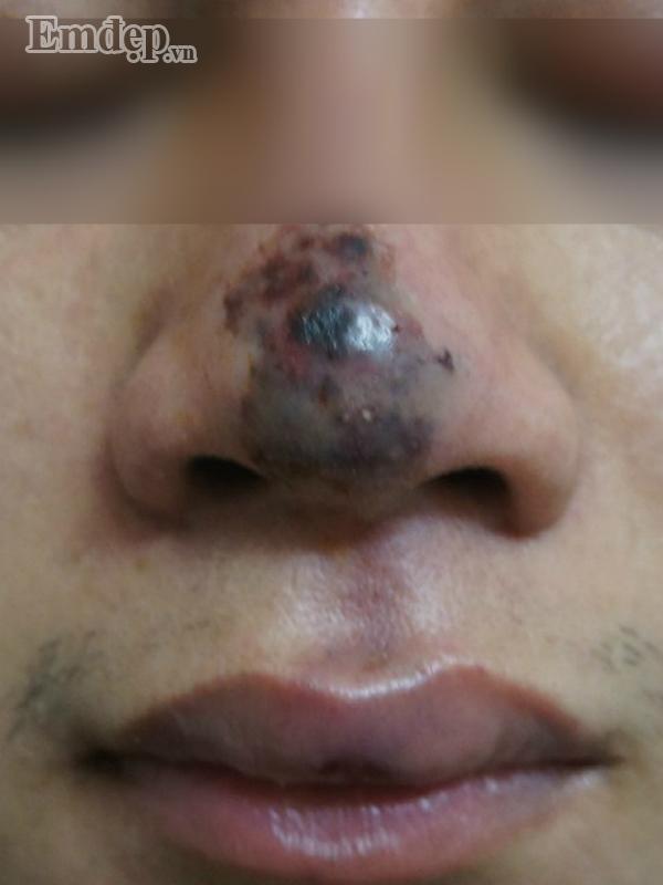 Bác sĩ thẩm mỹ rùng mình hút ra 20 cốc mủ từ ngực nạn nhân biến chứng nặng sau khi tiêm Filler rởm-3