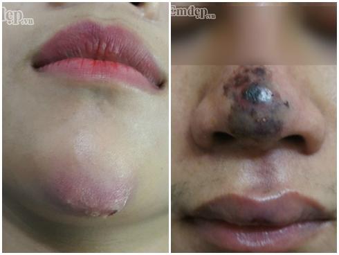 Bác sĩ thẩm mỹ rùng mình hút ra 20 cốc mủ từ ngực nạn nhân biến chứng nặng sau khi tiêm Filler 'rởm'